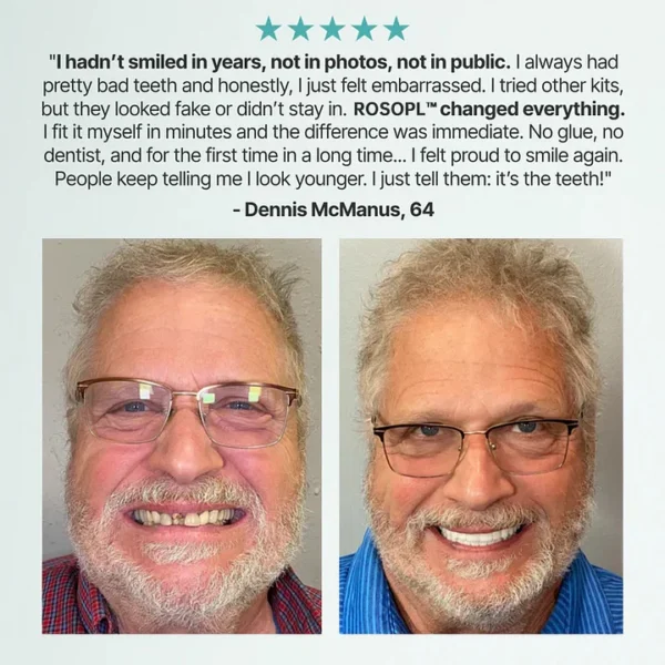 ROSOPL™ Custom-Fit Functional Dentures