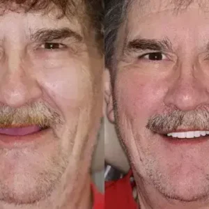 INSIDEEFY™ –🦷Advanced Customized Full Denture Set🦷 {Developed by Harvard University}