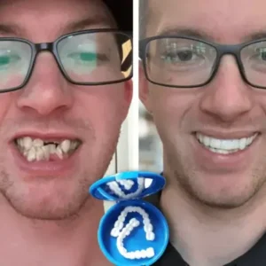 SmileFitPro™ — Custom-Fit, Affordable Denture Solution to Restore Your Natural Smile at Home