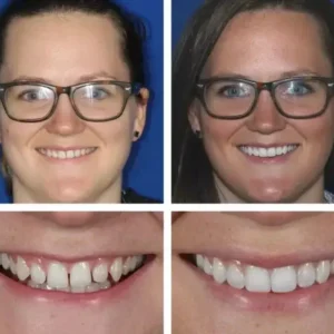 🦷SmileFitPro™ Instant Tooth Repair Gel – No Drills, No Pain, Fast at Home Fix!