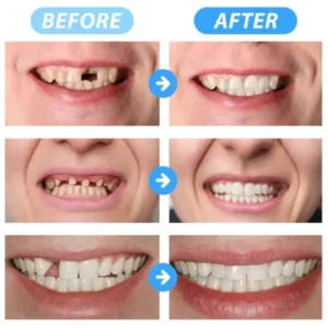 🦷SmileFitPro™ Instant Tooth Repair Gel – No Drills, No Pain, Fast at Home Fix!