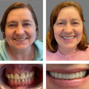 🦷SmileFitPro™ Instant Tooth Repair Gel – No Drills, No Pain, Fast at Home Fix!