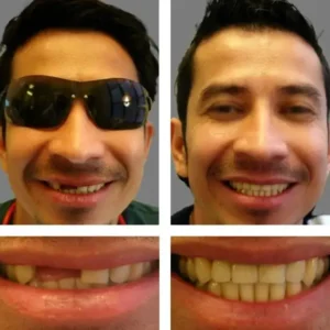 🦷SmileFitPro™ Instant Tooth Repair Gel – No Drills, No Pain, Fast at Home Fix!