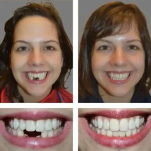 🦷SmileFitPro™ Instant Tooth Repair Gel – No Drills, No Pain, Fast at Home Fix!