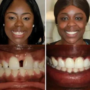 🦷SmileFitPro™ Instant Tooth Repair Gel – No Drills, No Pain, Fast at Home Fix!