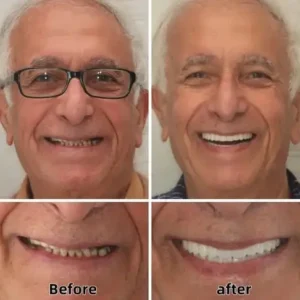 ✅ROSOPL™🦷 Custom Functional Denture Kits – Perfect fit inNinutes, Ready for use at Home
