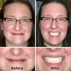 ✅ROSOPL™🦷 Custom Functional Denture Kits – Perfect fit inNinutes, Ready for use at Home