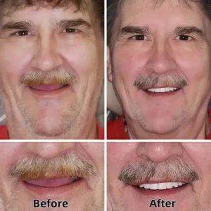 ✅ROSOPL™🦷 Custom Functional Denture Kits – Perfect fit inNinutes, Ready for use at Home