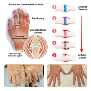 🐝 Offizieller Online-Shop丨Purelora® Bee Venom & Lithospermum Comfort Cream Wenn Gehen, Stehen oder Schlafen unangenehm wird — tägliche Schmerzlinderung & Knochenkomfort für ältere Erwachsene