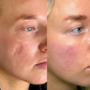 ODALIT™ Silicon ScarStick