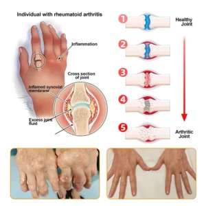 Purelora® Bee Venom Advanced Therapy - Deep Bone Healing & Instant Pain Relief Cream