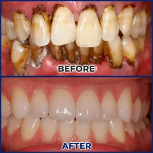 Rolimey® BeeTakt Bee Venom Dental Treatment Drops Mouthwash