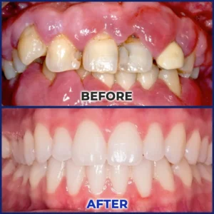 Rolimey® BeeTakt Bee Venom Dental Treatment Drops Mouthwash