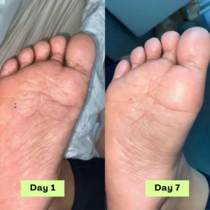 LOVILDS® AntiFungal Relief Soap Bar