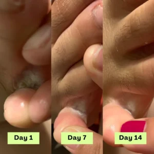 LOVILDS® AntiFungal Relief Soap Bar