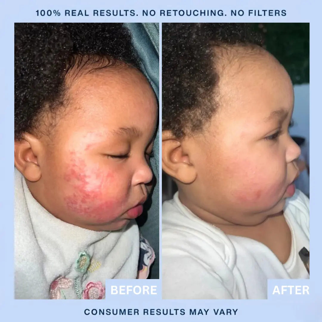 LOVILDS® Eczema & Psoriasis Cream