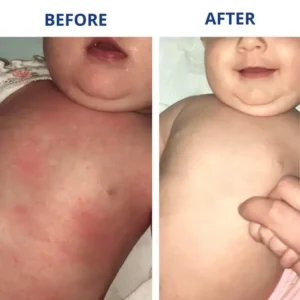 LOVILDS® Eczema & Psoriasis Cream