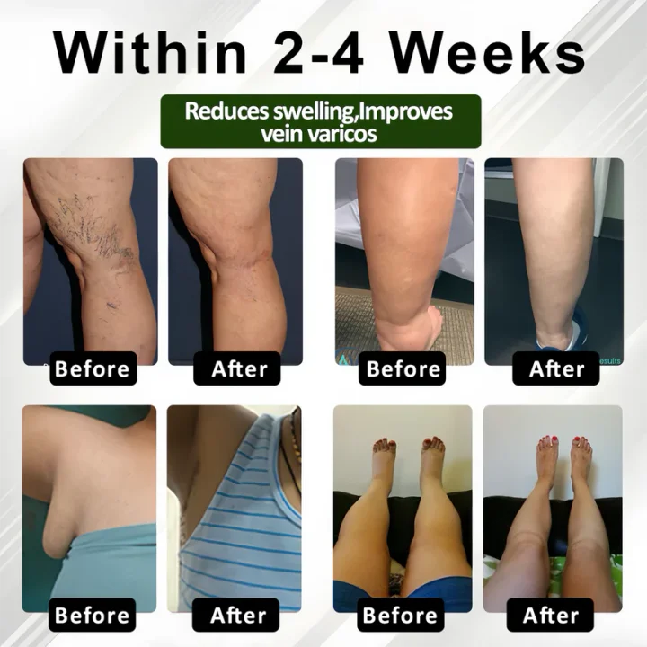 ROSOPL™ Leg Therapy Edema Cream