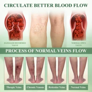 ROSOPL™ Leg Therapy Edema Cream