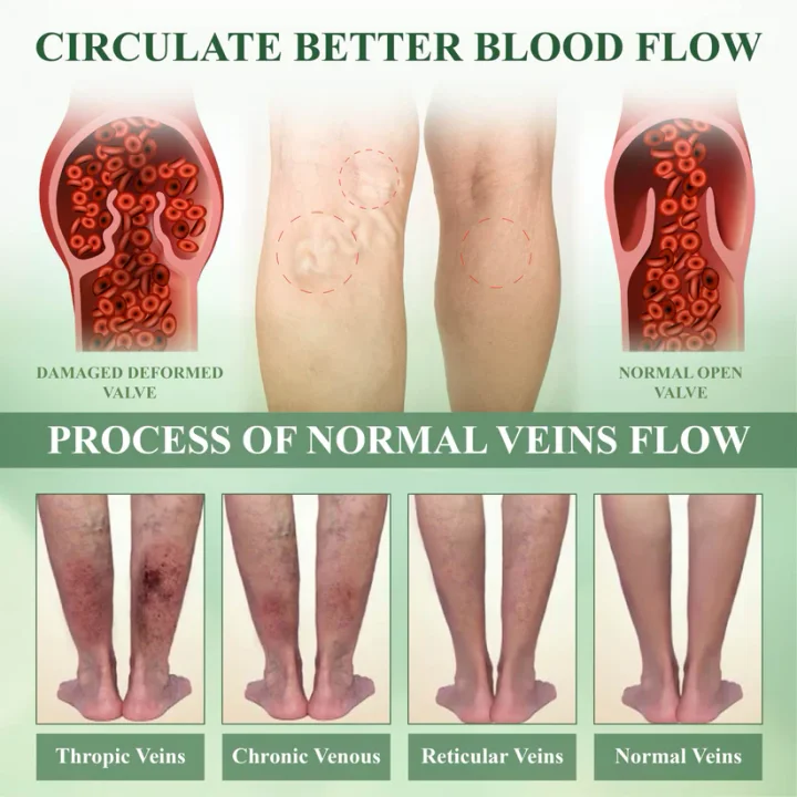 ROSOPL™ Leg Therapy Edema Cream