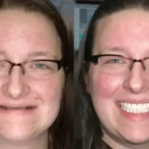 Custom-Fit Functional Dentures