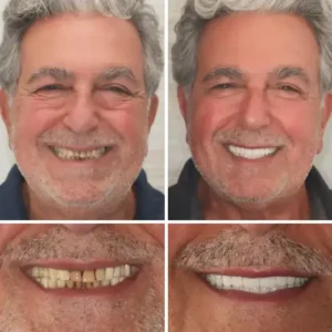 Custom-Fit Functional Dentures