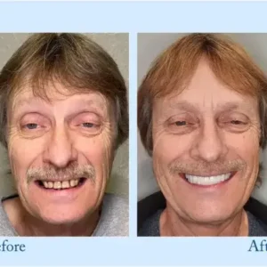 Hidone™ – Premium-Zahnprothese