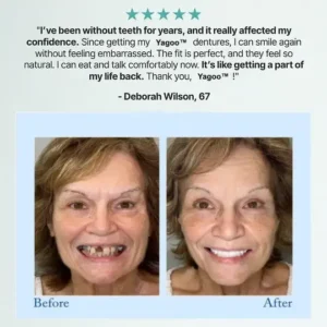 Rosopl® 🦷Advanced Customized Full Denture Set🦷 (🔥10,000+ Sold In Last 30 Day)