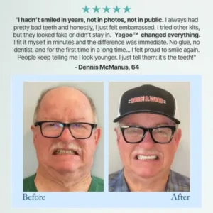 Rosopl® 🦷Advanced Customized Full Denture Set🦷 (🔥10,000+ Sold In Last 30 Day)