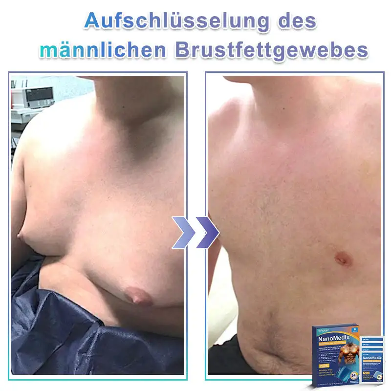 STARTYNX®NanoMedix™ Gynecomastia Breast Fat Burning & Firming Patch