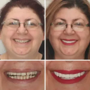 🌟 Vaxflite™ – Custom-Crafted Dentures That Feel as Natural as They Look👩🔬