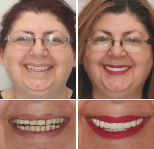 🌟 Vaxflite™ – Custom-Crafted Dentures That Feel as Natural as They Look👩🔬