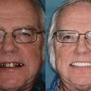 🌟 Vaxflite™ – Custom-Crafted Dentures That Feel as Natural as They Look👩🔬