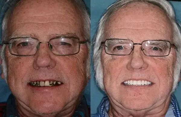 🌟 Vaxflite™ – Custom-Crafted Dentures That Feel as Natural as They Look👩🔬