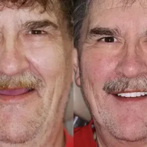 🌟 Vaxflite™ – Custom-Crafted Dentures That Feel as Natural as They Look👩🔬