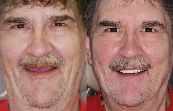 🌟 Vaxflite™ – Custom-Crafted Dentures That Feel as Natural as They Look👩🔬