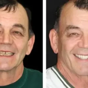 🌟 Vaxflite™ – Custom-Crafted Dentures That Feel as Natural as They Look👩🔬