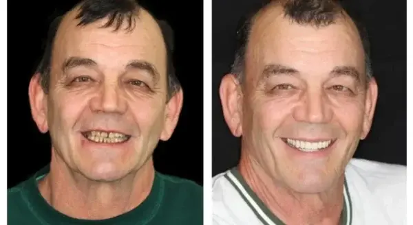 🌟 Vaxflite™ – Custom-Crafted Dentures That Feel as Natural as They Look👩🔬