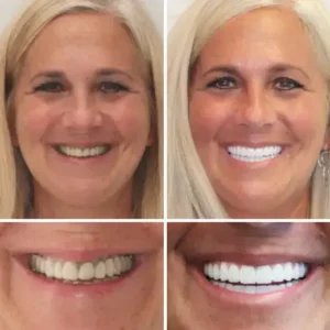 🌟 Vaxflite™ – Custom-Crafted Dentures That Feel as Natural as They Look👩🔬