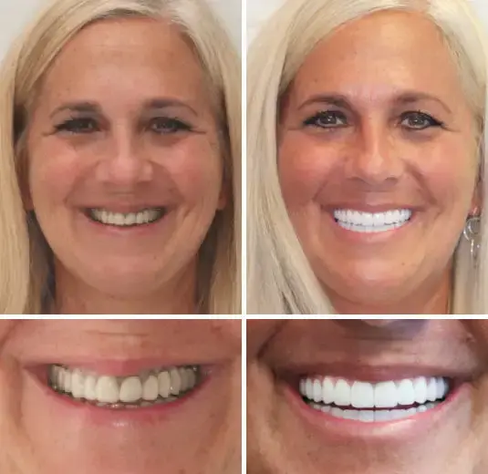 🌟 Vaxflite™ – Custom-Crafted Dentures That Feel as Natural as They Look👩🔬
