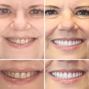 🌟 Vaxflite™ – Custom-Crafted Dentures That Feel as Natural as They Look👩🔬