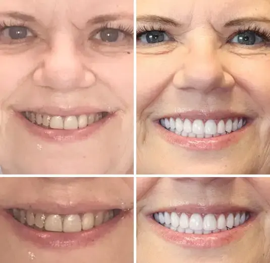 🌟 Vaxflite™ – Custom-Crafted Dentures That Feel as Natural as They Look👩🔬