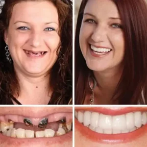 Heaceitr® Premium Full Denture Set