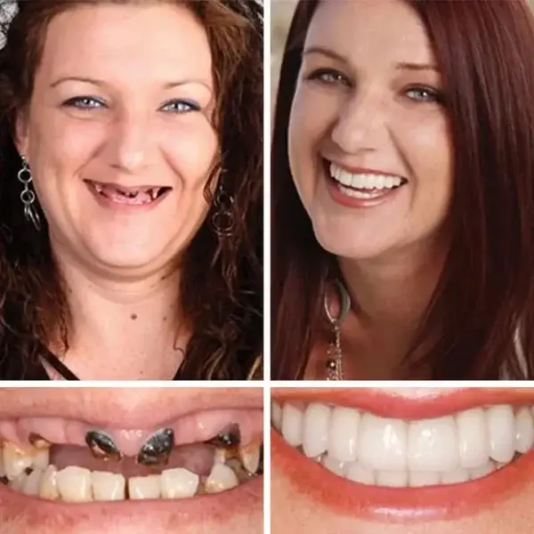 Heaceitr® Premium Full Denture Set