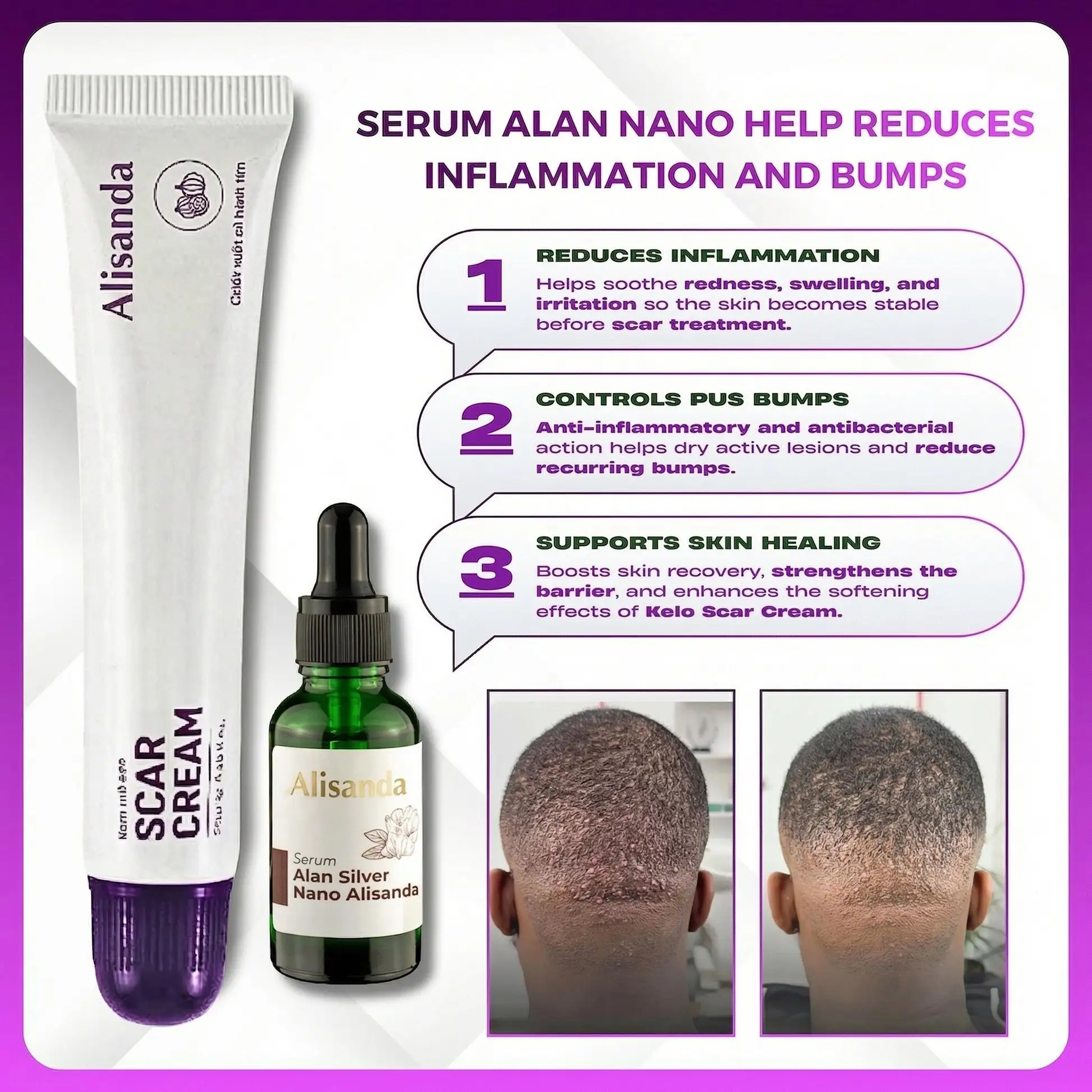 Keloid & Raised Scar Removal Cream | Alisanda 2026