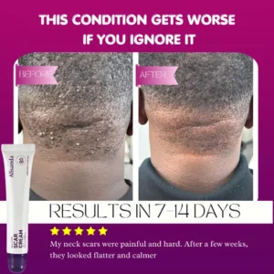 Keloid & Raised Scar Removal Cream | Alisanda 2026