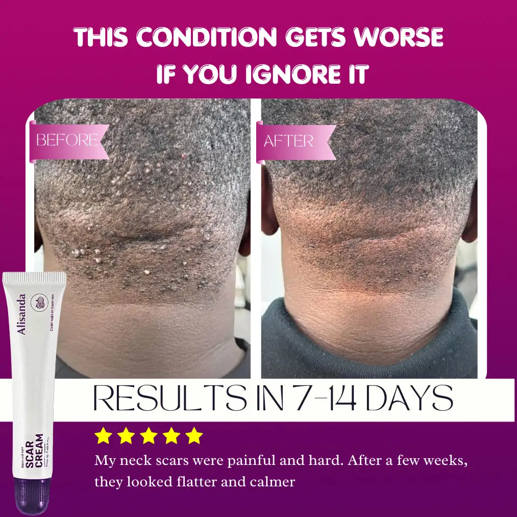 Keloid & Raised Scar Removal Cream | Alisanda 2026