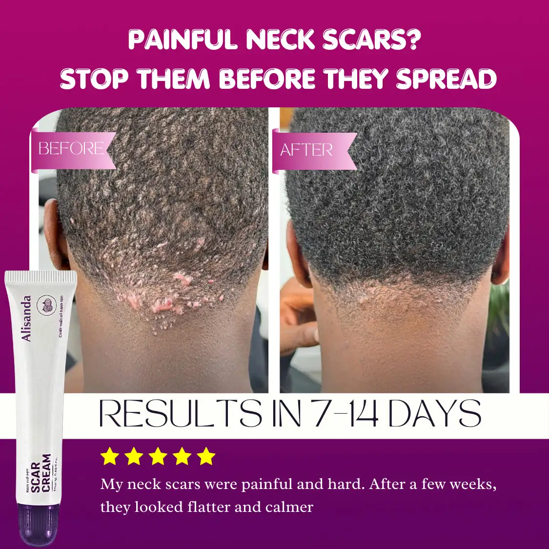 Keloid & Raised Scar Removal Cream | Alisanda 2026