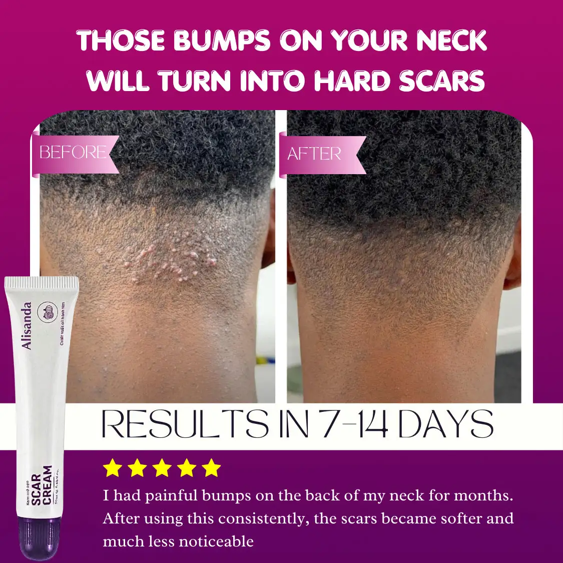 Keloid & Raised Scar Removal Cream | Alisanda 2026