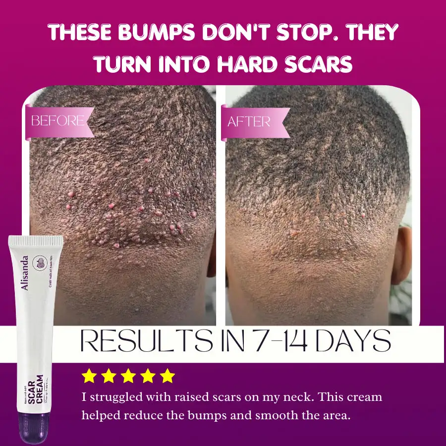 Keloid & Raised Scar Removal Cream | Alisanda 2026